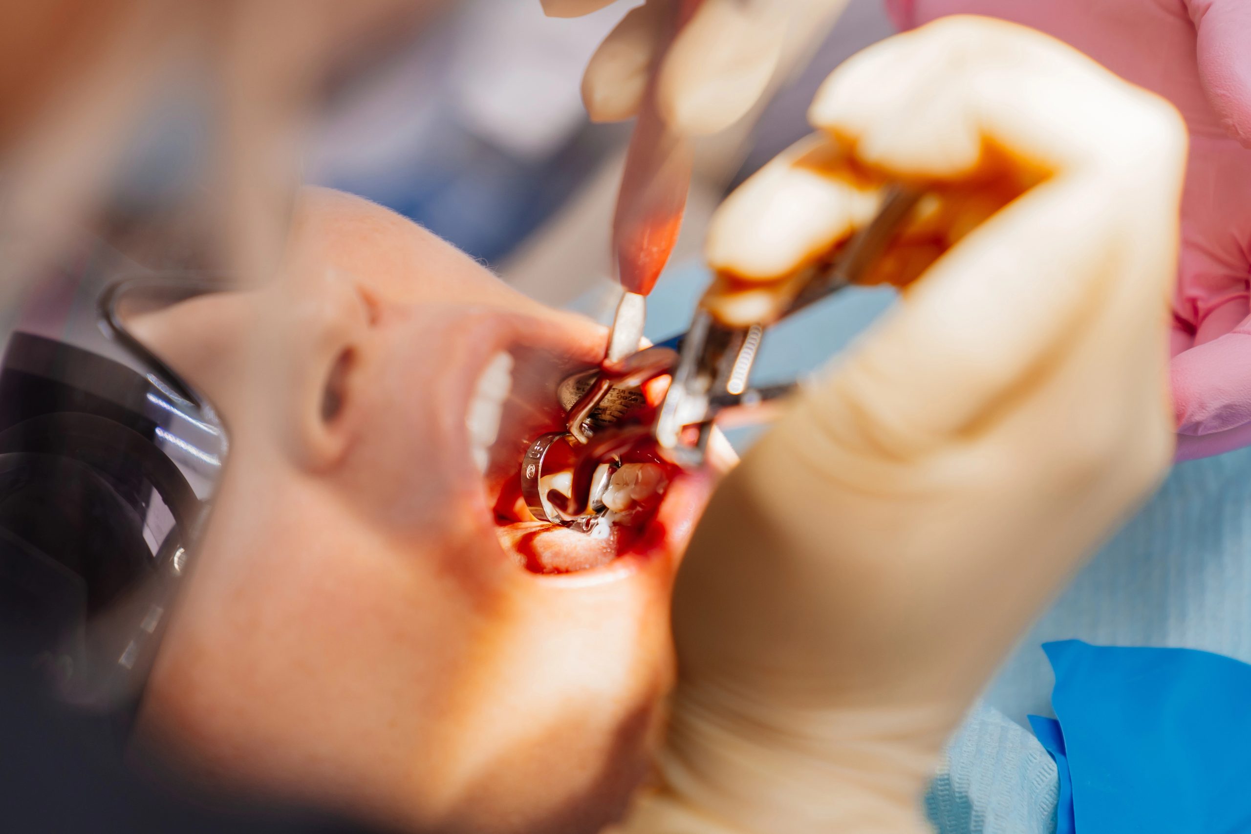 Tooth Extractions