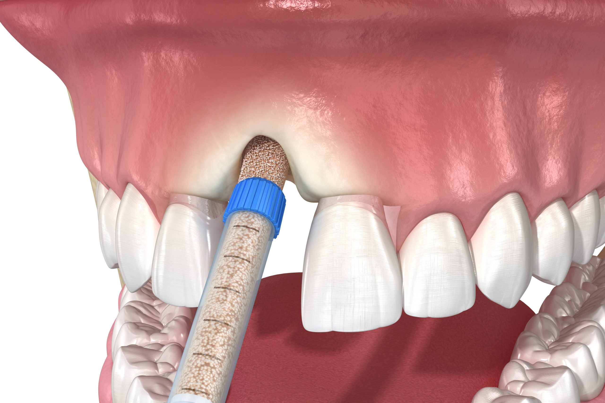 Bone Grafting