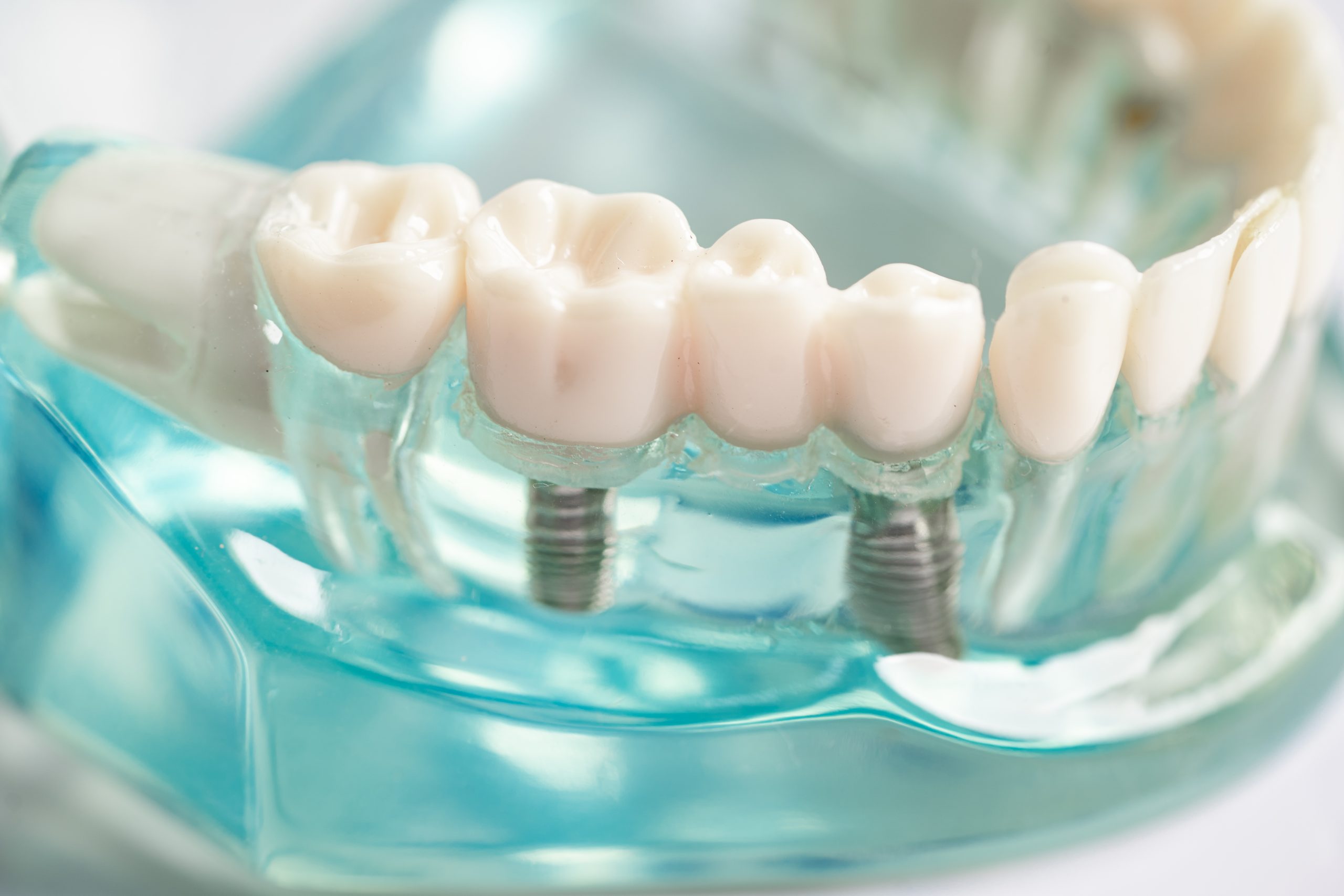 Dental Implants